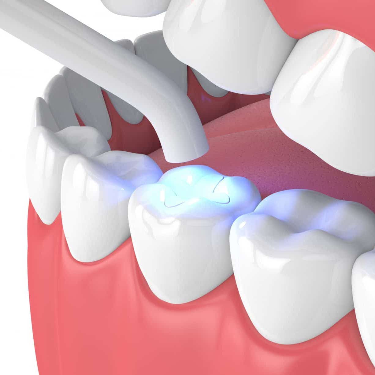 cosmetic-fillings