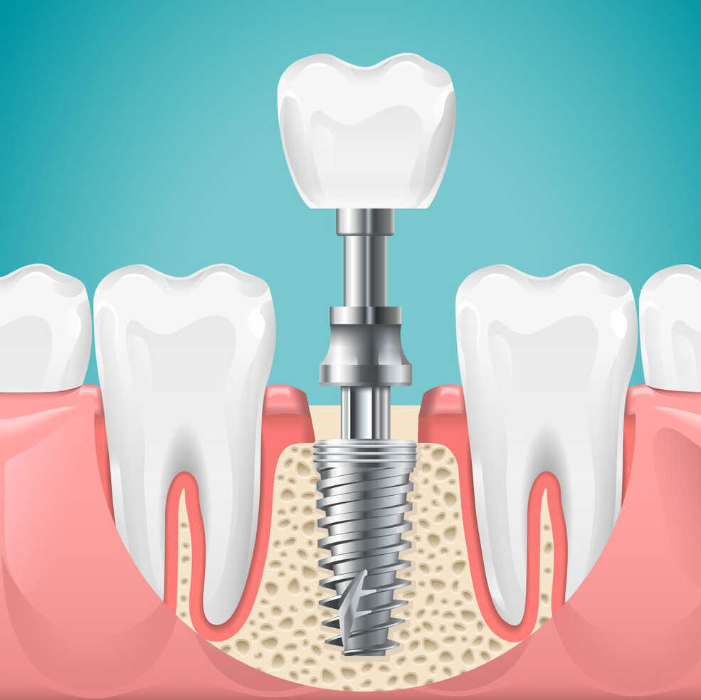dental-implants
