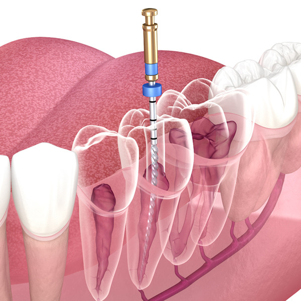 root-canal-treatments