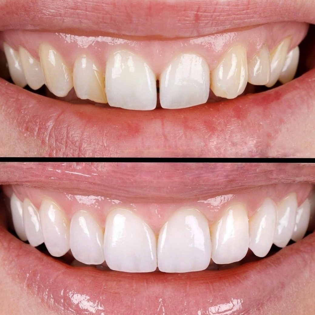 teeth-whitening